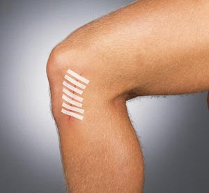 INTEGRA LIFESCIENCES SUTURE STRIP® WOUND CLOSURE STRIPS